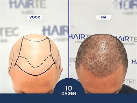 Haartransplantatie En Levensstijl: Wat Te Vermijden