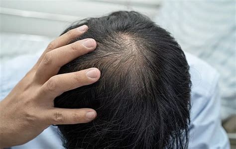 Haartransplantatie Mythen: Feiten En Fictie