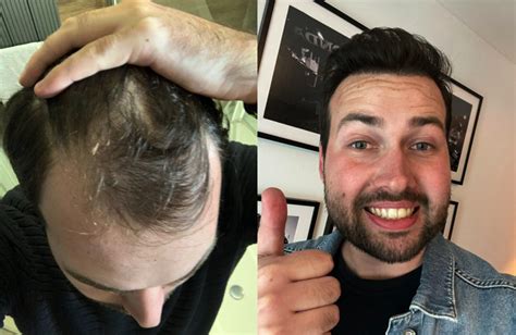 Haartransplantatie Voor Jonge Mannen: Is Het Aanbevelenswaardig?