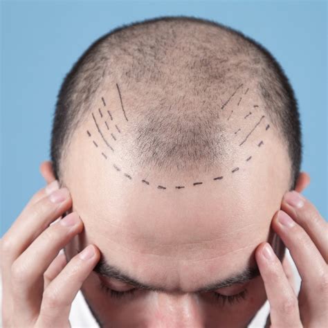 Het Belang Van Een Consult Voor Haartransplantatie